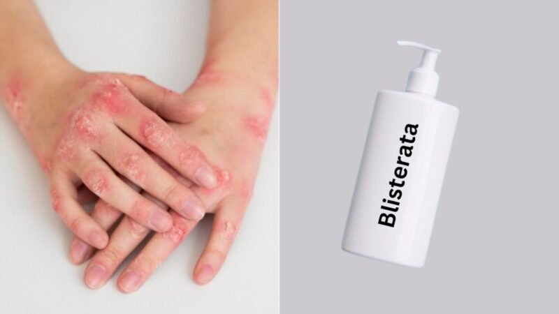 Blisterata: How to Apply It to Skin? Side Effects & Solutions 